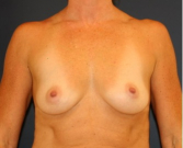 Feel Beautiful - Breast Augmentation 152 - Before Photo
